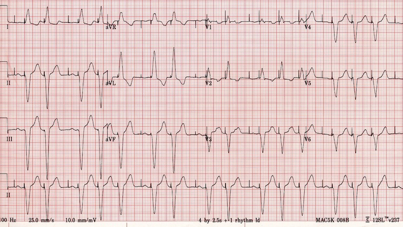 Ecg5